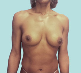 Breast Implant Removal & Replacement, 450cc to 700cc