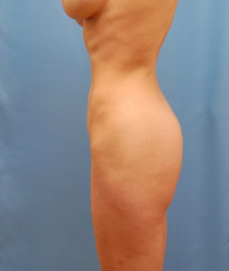 High Definition Liposuction & Body Contouring Fat Transfer to the Buttocks, Tummy Tuck