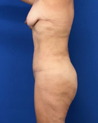 Modern Abdominoplasty & Body Contouring