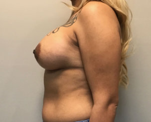 Did She Get a Breast Lift? Where Are Her Scars?