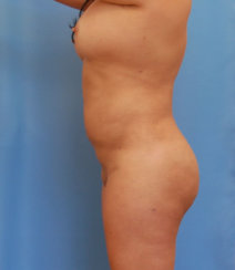 Brazilian Butt Lift & Body Contouring