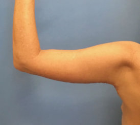 Arm Lift (Correction of Sagging Arm Skin) 