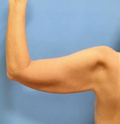 Arm Lift (Correction of Sagging Arm Skin) 