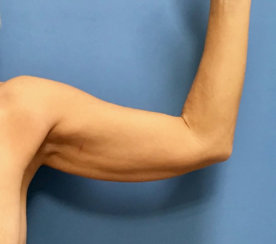 Arm Lift (Correction of Sagging Arm Skin) 