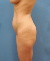 High Definition Liposuction & Body Contouring Fat Transfer to the Buttocks, Tummy Tuck