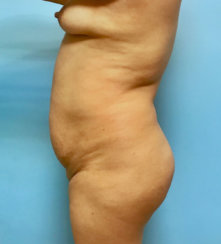 Abdominoplasty & Body Contouring  