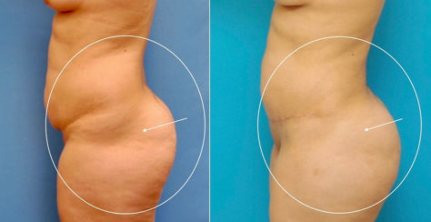 Body Transformation: Modern Abdominoplasty & Brazilian Butt Lift, Correction of Buttock Dimples