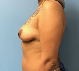 Did She Get a Breast Lift? Where Are Her Scars?