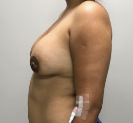 Breast Implant Revision