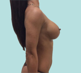 Breast Implant Revision: Correction Of Breast Implant Rippling & Cleavage Creation