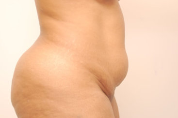 Modern Abdominoplasty