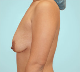 Breast Augmentation with Breast Lift at The Same Time, Augmentation & Mastopexy, Vertical Lift, Mommy Makeover