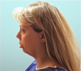 Facelift  and Neck Lift and Lower Eyelid Suregry and Browlift