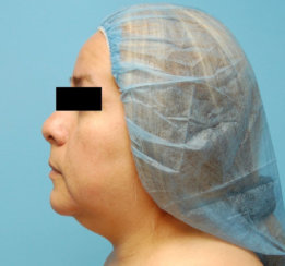 Double Chin Correction - Liposuction of the Neck