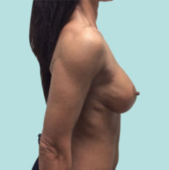 Breast Implant Revision: Correction Of Breast Implant Rippling & Cleavage Creation