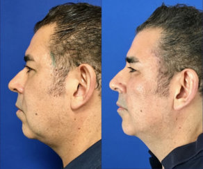 Minimally Invasive Facelift Elevation 