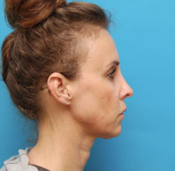 Closed Rhinoplasty, Correction of Laugh Lines & Lip Augmentation