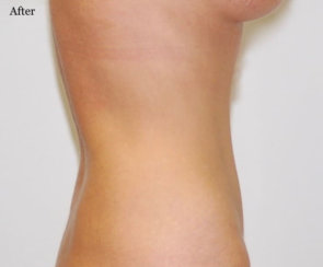 Standard Abdominoplasty & Liposuction 