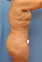 Breast Reconstruction & Abdominoplasty