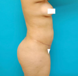 Body Transformation: Modern Abdominoplasty & Brazilian Butt Lift, Correction of Buttock Dimples