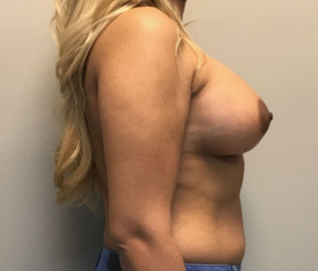 Did She Get a Breast Lift? Where Are Her Scars?