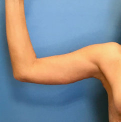 Arm Lift (Correction of Sagging Arm Skin) 