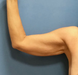 Arm Lift (Correction of Sagging Arm Skin) 