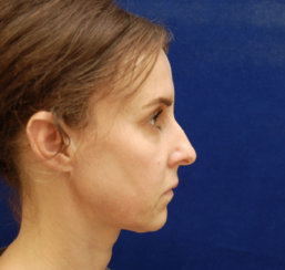 Closed Rhinoplasty, Correction of Laugh Lines & Lip Augmentation