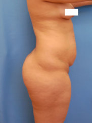 Body Transformation: Modern Abdominoplasty & Brazilian Butt Lift, Correction of Buttock Dimples