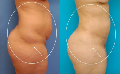 Body Transformation: Modern Abdominoplasty & Brazilian Butt Lift, Correction of Buttock Dimples