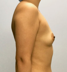 Breast Augmentation: Breast Asymmetry Correction