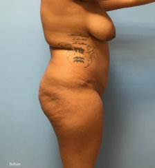 Brazilian Butt Lift, Hips Sculpture, Correction of Buttock Dimples & Cellulite