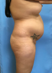 Brazilian Butt Lift & Body Contouring