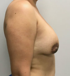 Breast Implant Revision