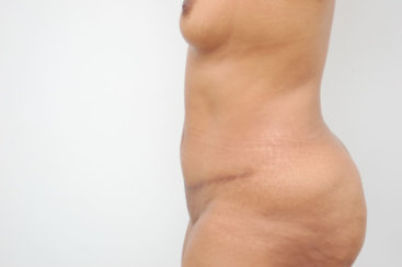 Modern Abdominoplasty