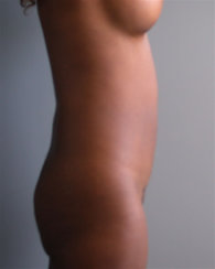Breast Augmentation & Abdominal Liposuction