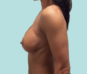 Breast Implant Revision: Correction Of Breast Implant Rippling & Cleavage Creation