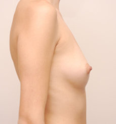 Breast Augmentation & Breast Asymmetry Correction