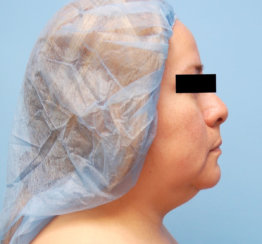 Double Chin Correction - Liposuction of the Neck