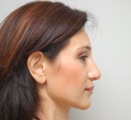 Rhinoplasty & Septoplasty