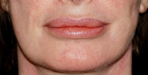 Lip Augmentation with Fat Transfer