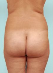 Liposuction of Abdomen and Back
