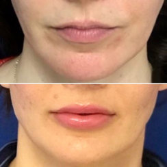Lip Augmentation with Fat Transfer
