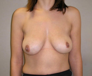 Breast Lift, Breast Reduction