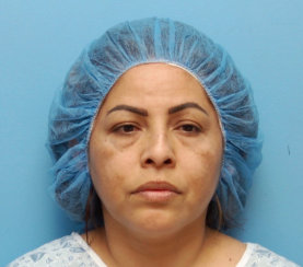 Rhinoplasty, Septoplasty & Resection of Lip Tumor