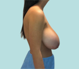 Breast Reduction, Breast Lift