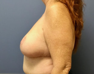 Breast Reduction, Breast Reconstruction