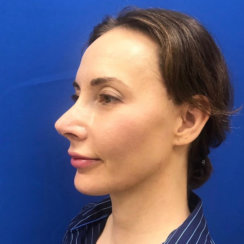 Minimally Invasive Midface Suspension (MIMS) and Fat Transfer to Face
