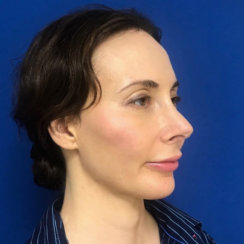 Minimally Invasive Midface Suspension (MIMS) and Fat Transfer to Face