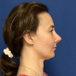 Minimally Invasive Midface Suspension (MIMS) and Fat Transfer to Face